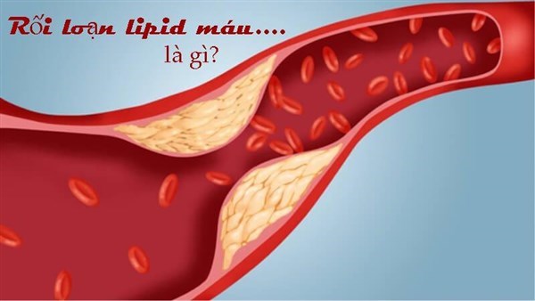 Rối loại lipid máu và biểu hiện 