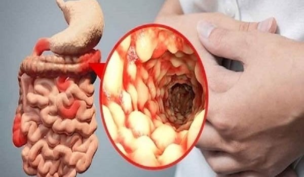 Crohn : Nguyên nhân , triệu chứng, điều trị 