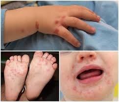 Bệnh tay chân miệng ở trẻ em có nguy hiểm không ?