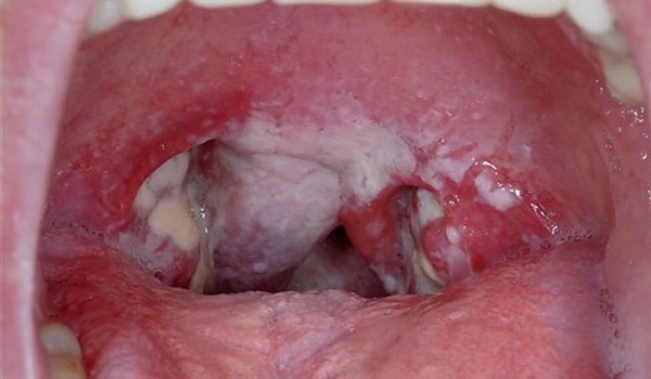 Viêm họng nhiễm khuẩn : Những điều cần biết 
